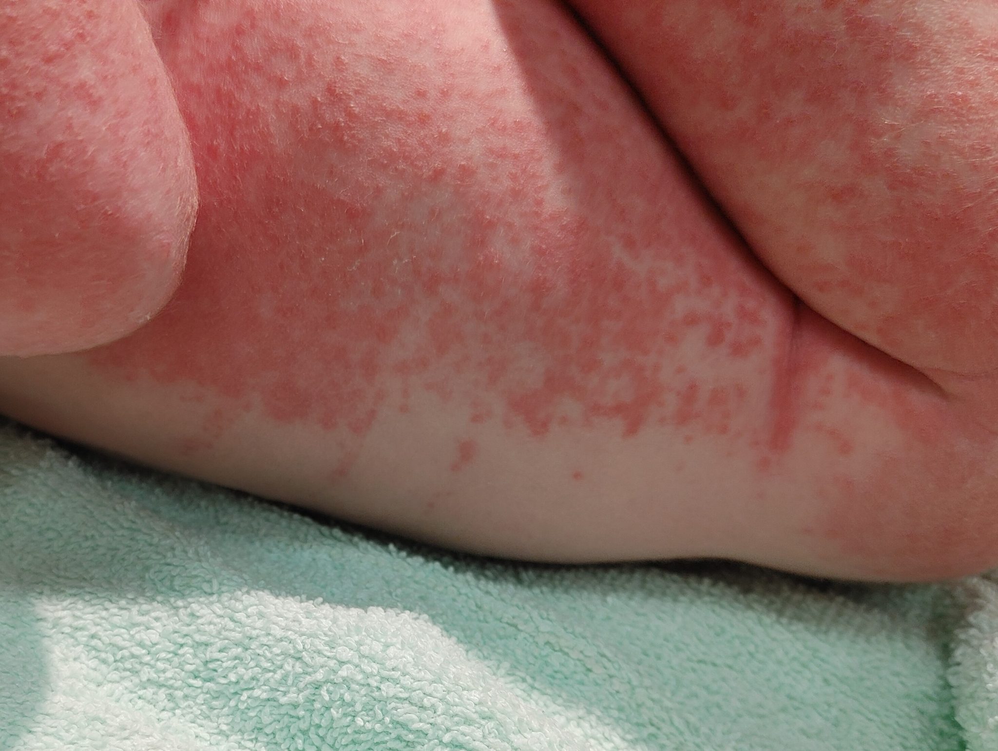 Benign Skin Changes Of The Newborn Pediatric Dermatology