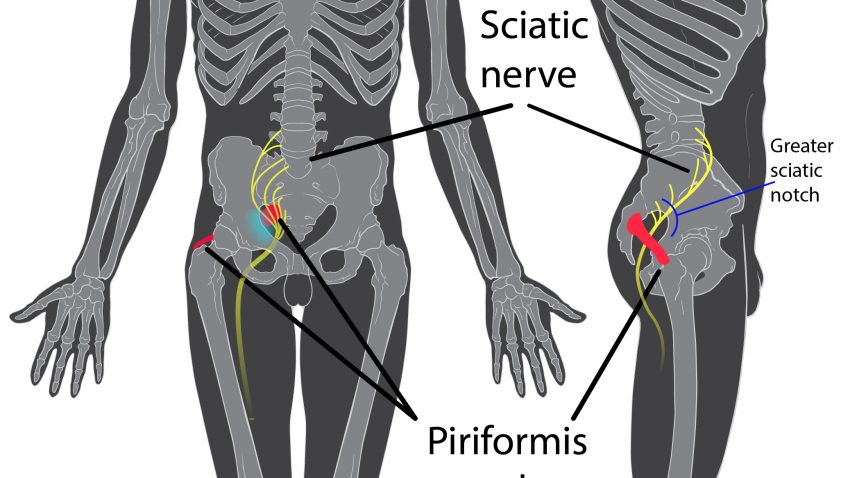 superior gluteal nerve injection