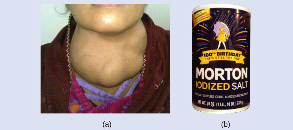 Figure A shows a photo of a person who has a very swollen thyroid in his or her neck. Figure B shows a photo of a canister of iodized salt.
