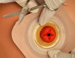 Assess flange for proper fit to stoma