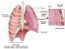 10.6 Chest Tube Drainage Systems – Clinical Procedures for Safer ...