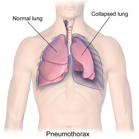 Even without knowing the latest in thoracic drainages? Discover the Sinapi.