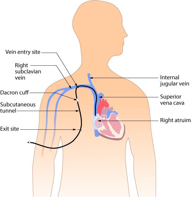 8.3 Types of Venous Access – Clinical Procedures for Safer Patient Care