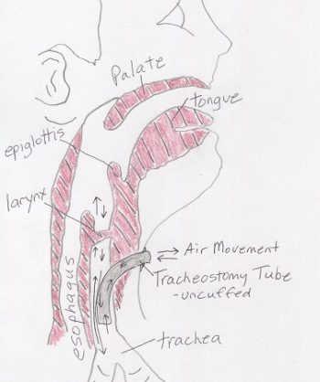 10.5 Tracheostomies – Clinical Procedures for Safer Patient Care