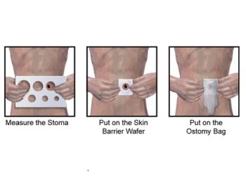 11.2 Ostomy Care – Clinical Procedures For Safer Patient Care