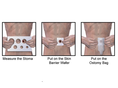 Stoma Care: Changing the Pouch, Step-by-Step