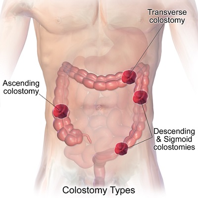 A) Illustrates functional loop ileostomy with stoma bag applied