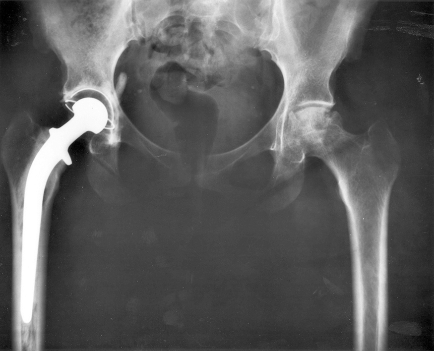 An x-ray image of a person’s hips. The right hip joint (on the left in the photograph) has been replaced. A metal prosthesis is cemented in the top of the right femur and the head of the femur has been replaced by the rounded head of the prosthesis. A white plastic cup is cemented into the acetabulum to complete the two surfaces of the artificial ball and socket joint.