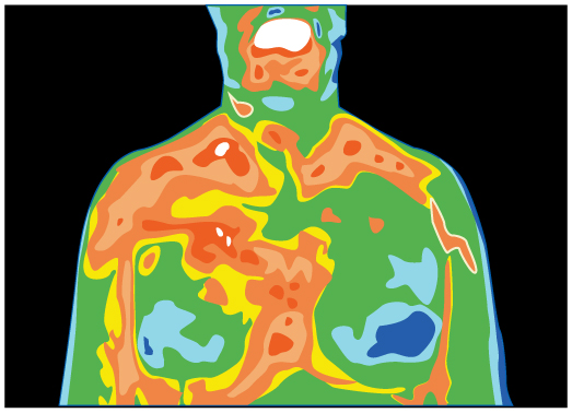 A thermograph of the chest area of a patient is shown. There are different colors showing different thermal regions.