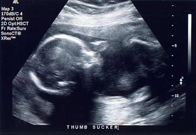 An ultrasound image of a 21 week old fetus.