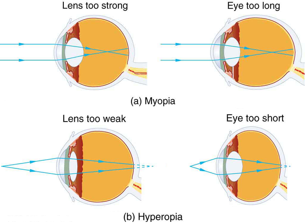 26.2 Vision Correction \u2013 College Physics: OpenStax