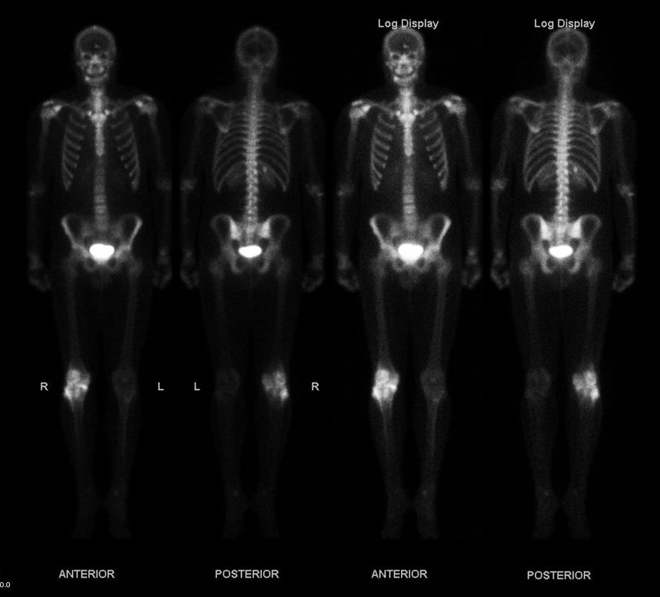 This figure shows four images of a skeleton of a human. Different parts of the body show bright spots wherever the bone cells are most active, indicating bone cancer.