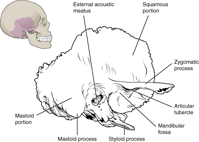 This image shows the location of the temporal bone. A small image of the skull on the top left shows the temporal bone highlighted in pink and a magnified view of this region then highlights the important parts of the temporal bone.