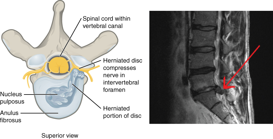 This figure shows a herniated disk. The left panel shows the superior view highlighting how the herniated disk compresses the nerve. The right panel shows a photograph of a herniated disk.