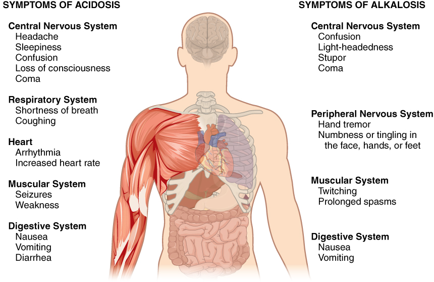 This figure points out the symptoms of acidosis and alkalosis on a silhouette of a human torso. The effects of acidosis on the central nervous system include headache, sleepiness, confusion, loss of consciousness and coma. The effects of acidosis are given on the left side of the diagram. The effects of acidosis on the respiratory system include shortness of breath and coughing. The effects of acidosis on the heart include arrhythmia and increased heart rate. The effects of acidosis on the muscular system include seizures and weakness. The effects of acidosis on the digestive system include nausea, vomiting and diarrhea. The right side of the diagram describes the symptoms of alkalosis. The effects of alkalosis on the central nervous system include confusion, light-headedness, stupor, and coma. The effects of alkalosis on the peripheral nervous system include hand tremor and numbness or tingling in the face, hands, and feet. The effects of alkalosis on the muscular system include twitching and prolonged spasms. The effects of alkalosis on the digestive system include nausea and vomiting.