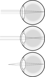 For distant vision, the lens is flat to reduce refraction to a minimum (top image). If the lens were to bulge as shown in the middle image, it would cause too much refraction, changing the direction of the incoming light rays too much, so they would focus in front of the retina and could not be focussed. For viewing nearby objects, however, the light rays need to be refracted more than rays coming from distant objects; a bulging lens allows focussing on nearby objects (bottom image). Although there is extensive refraction by the cornea, this refraction is constant and so is not shown in these images.