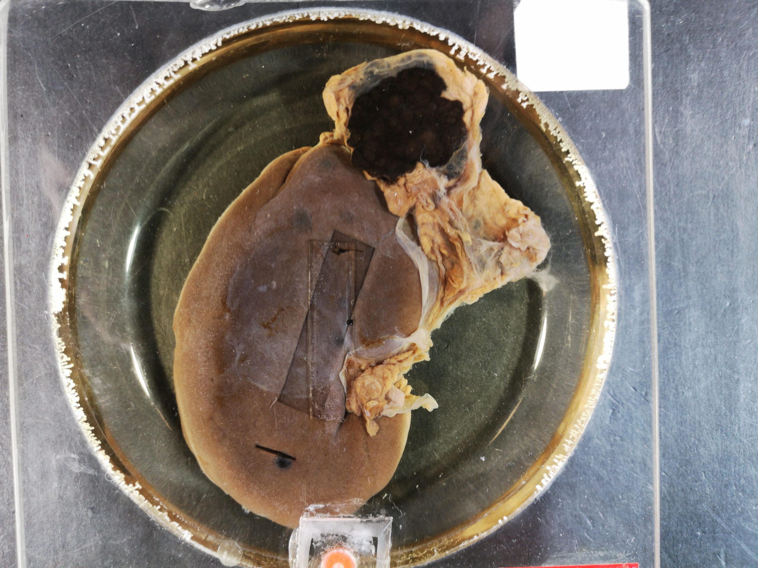 Posterior view of kidney and adrenal with melanoma metastasis. The melanoma is about quarter the size of the kidney