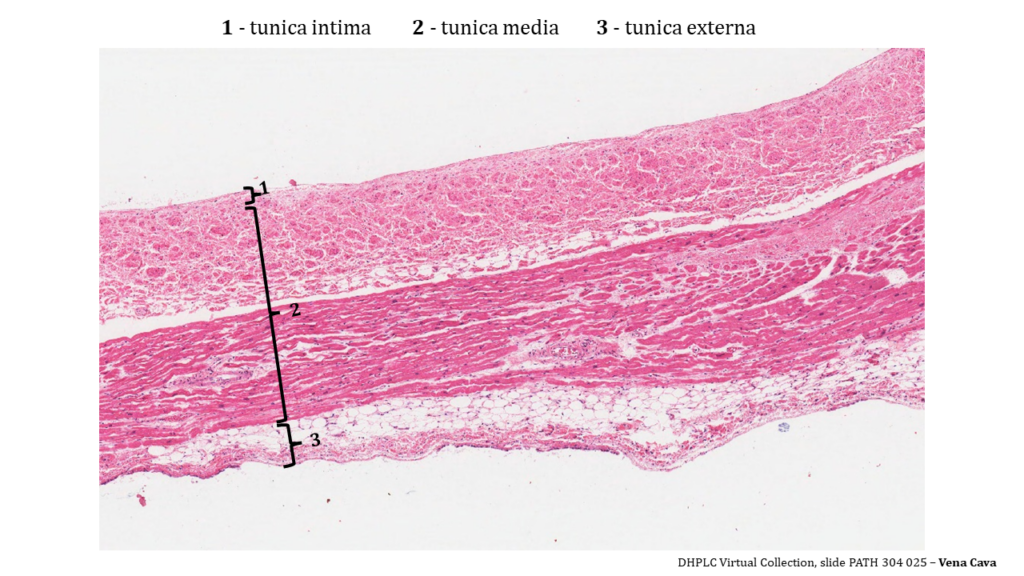 layers of the vena cava is visible and enumerated with 1 (tunica intima) at the top of the image, 2 (tunica media) which fills up the middle of the image), and 3 (tunica externa) which occupies the bottom. All three tunica stain an intense dark pink. The tunica intima and top half of the media are round clusters, arranged in layers. The bottom half of the tunica media shows long dark pink cells with purple nuclei. The externa has a variety of tissues including fat (all white with no stain), and dark pink with purple nuclei.