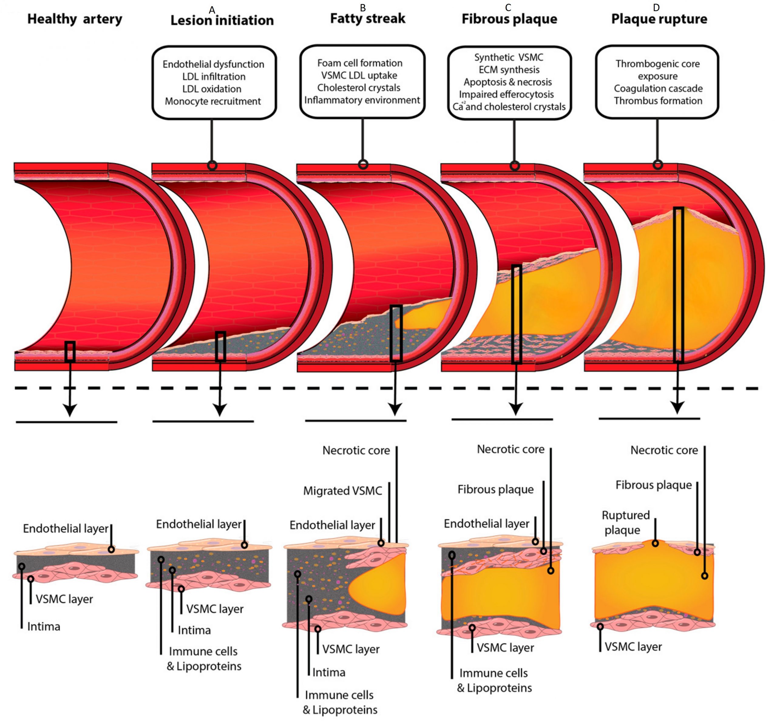 Segments of an artery in developing stages of atherosclerosis are shown, with a lower panel that focusses the tunica intima and tunica media layers. The health artery shows a negligible space in the intima between the endothelial and smooth muscle layers. As the artery progresses to atherosclerosis, more immune cells and lipoproteins begin to fill the intimal space. As the fatty streak develops into a plaque, foam cells form a large plaque with a necrotic core AND smooth muscle cells grow both above and below the plaque. The fibrous atherosclerotic plaque has a cap of smooth muscle cells between the endothelial layer and the necrotic core. When the plaque ruptures, the necrotic core has breached both the smooth muscle and endothelial layers, exposing it to the blood.