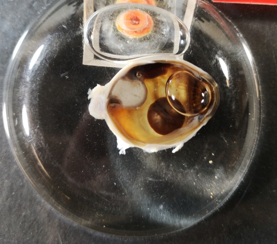 the interior of the eye is visible with the lens/pupil on the right and the optic nerve on the left. A very large brown melanoma "mole' is in the centre of the vitreous chamber, taking up approximately a quarter of the view.