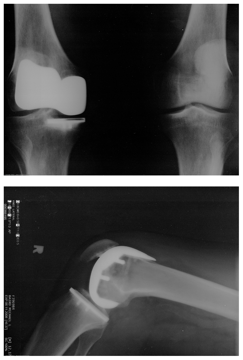 Two X-x rays of an artificial knee replacement are shown.