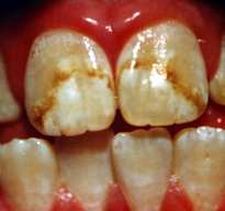 Fluorosis