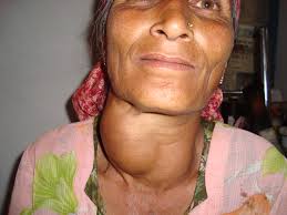 A woman with a large goiter on her neck