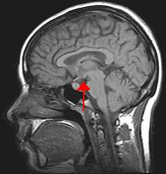 A sagittal view of the brain