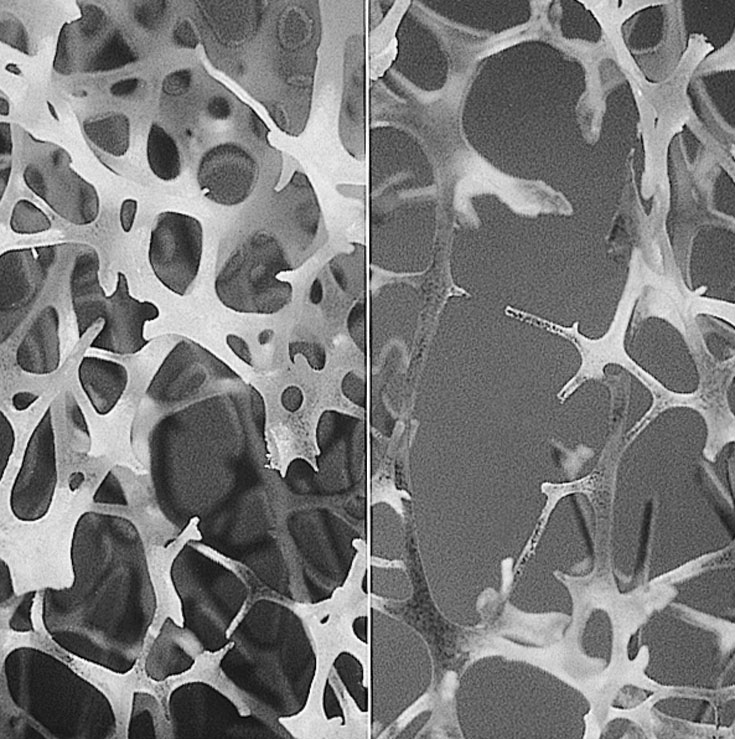 Normal and degraded trabecular bone