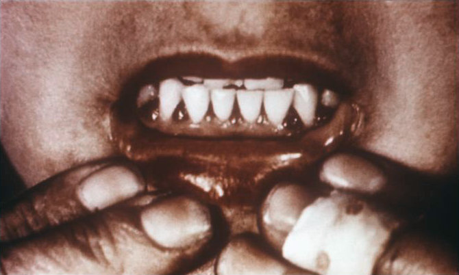 Bleeding gums associated with scurvy