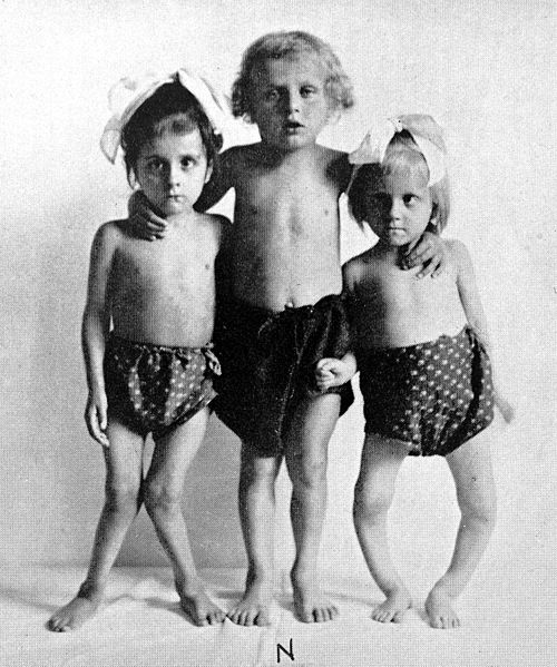 Three children with rickets