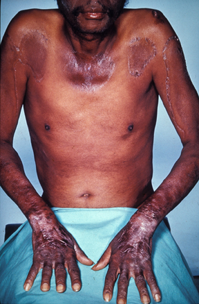 A man affected by niacin deficiency