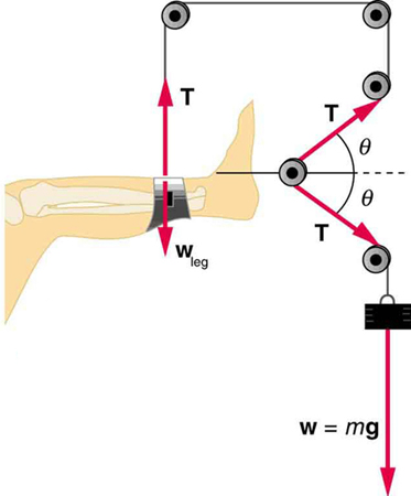 Diagram of a leg in traction.
