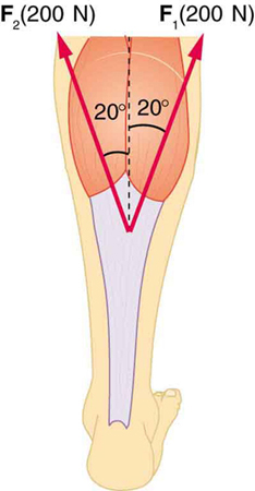 An Achilles tendon is shown in the figure with two forces acting upward, one at an angle of plus twenty degrees, one at minus twenty degrees. F sub one, equal to two hundred newtons, is shown by a vector making an angle twenty degrees toward the right with the vertical, and F sub two, equal to two hundred newtons, is shown making an angle of twenty degrees left from the vertical.