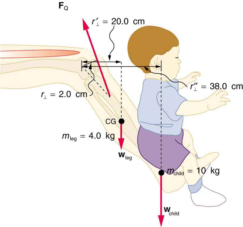 A leg of a person is shown. On the foot, a child is sitting. The weight of the child is ten kilograms acting downward. The center of gravity of the leg is shown at the middle part of the lower leg. The knee is acting as the pivot. The mass of the leg is marked as four kilograms. The distance of the head of the child is thirty eight centimeters from the pivot and the perpendicular distance between the center of gravity of the leg and pivot is twenty centimeters.