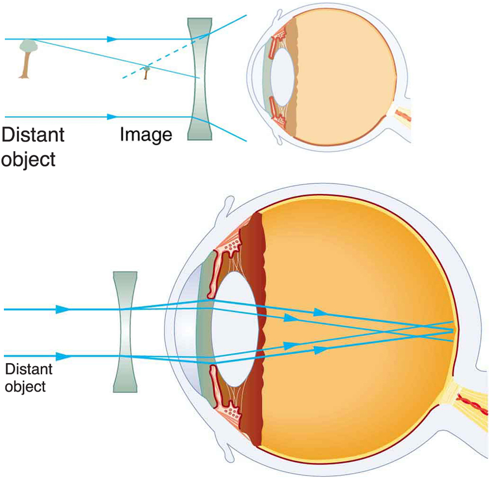 Two illustrations of cross-sectional view of an eye are shown. In the first figure, a diverging spectacle lens is placed in front of the eye structure. A ray diagram for the diverging lens is also shown. Parallel rays from a distant object, taken as tree, are striking the lens and then diverging. A smaller image of the tree is shown in front of the lens. In the second figure, a ray diagram with respect to the diverging lens within the eye structure is shown. Parallel rays from a distant object are striking the diverging lens, entering the lens of the eye, and converging at retina. This explains the correction of nearsightedness using a diverging lens.