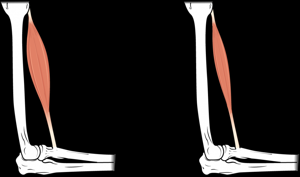 This image shows muscle atrophy. The left panel shows normal muscle and the right panel shows atrophied muscle.