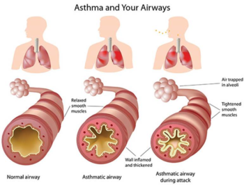 5.3 Conditions and Diseases Related to Gas Exchange – Nursing Pharmacology