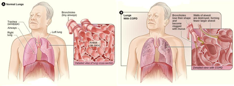 5.3 Conditions and Diseases Related to Gas Exchange – Nursing Pharmacology