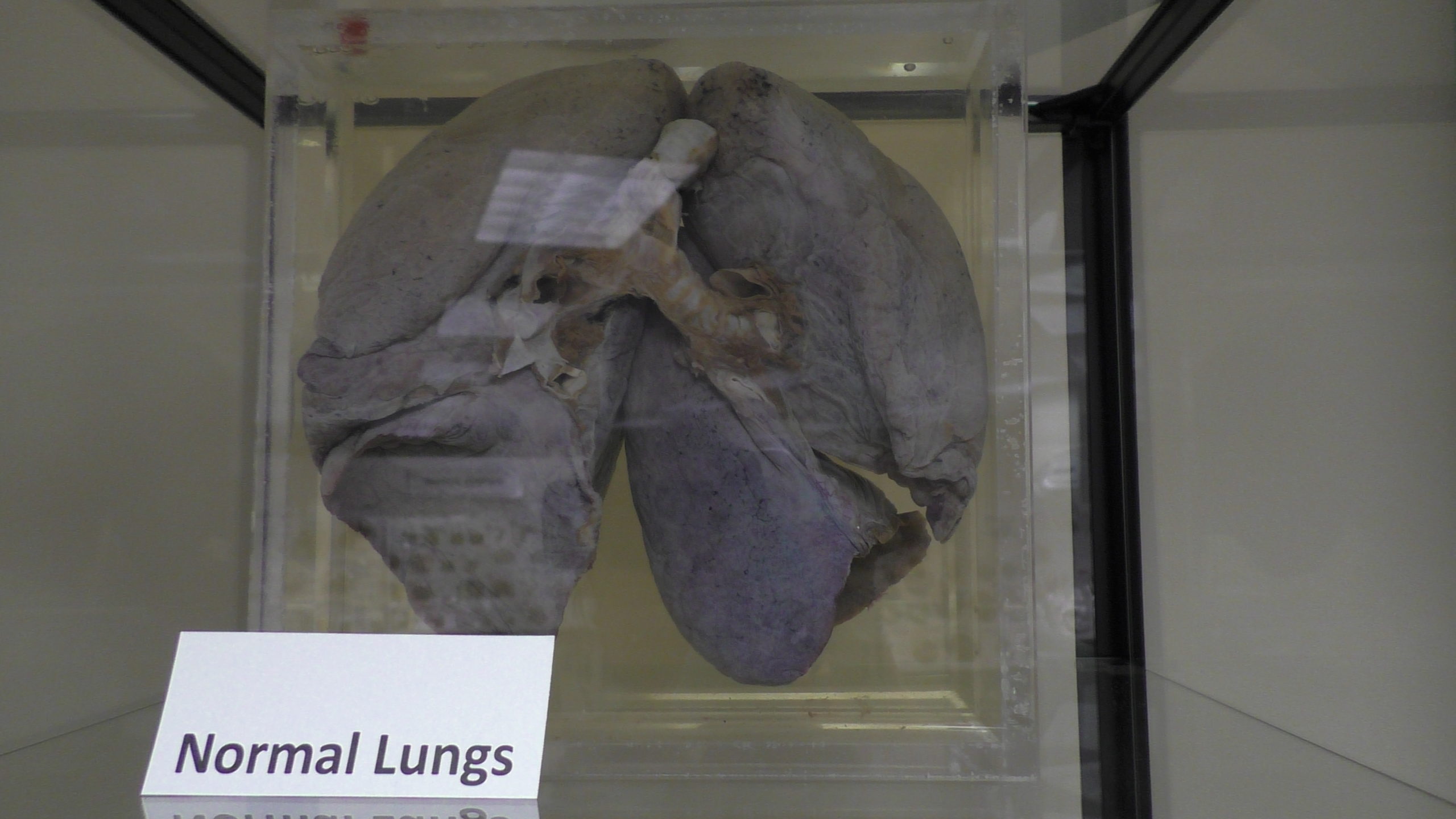 normal lungs from healthy woman with visible trachea, bronchi, and lung lobes.