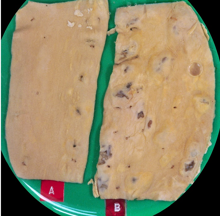 This figure shows the normal appearance of the lining of the aorta and the changes to appearance in mild atheropsclerosis