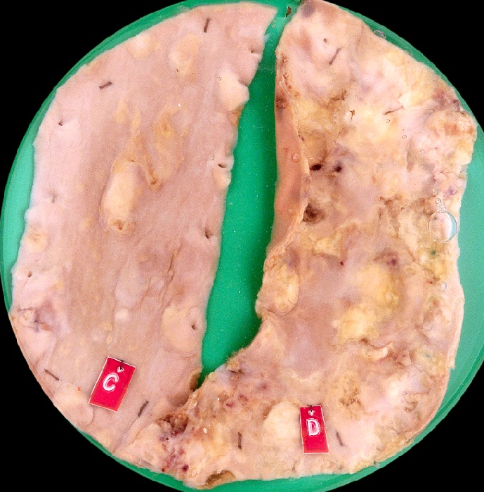 This figure shows progression of atherosclerosis of the aorta from moderate to severe at the gross level