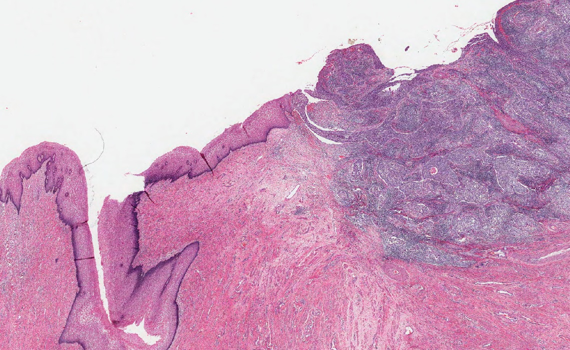 The figure show the changes at the microscopic level of cervical cancer