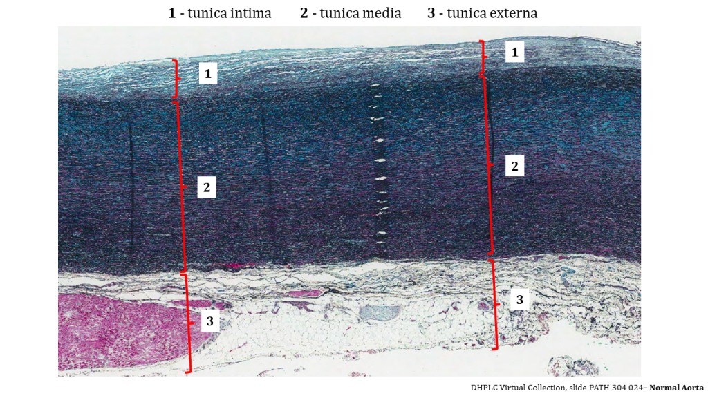 layers of the aorta is visible and enumerated with 1 (tunica intima) at the top of the image, 2 (tunica media) which fills up the middle of the image), and 3 (tunica externa) which occupies the bottom. The top 2 tunica stain a dark blue/black with a background colour of pink, with a sense of parallel layers. The tunica intimal layer show a light blue with discrete layers of cells atop each other. The medial layer is dark blue/black with pink suggesting a lot of collagen and elastin. The externa has a variety of tissues including fat (all white with no stain), and dark pink with purple nuclei.