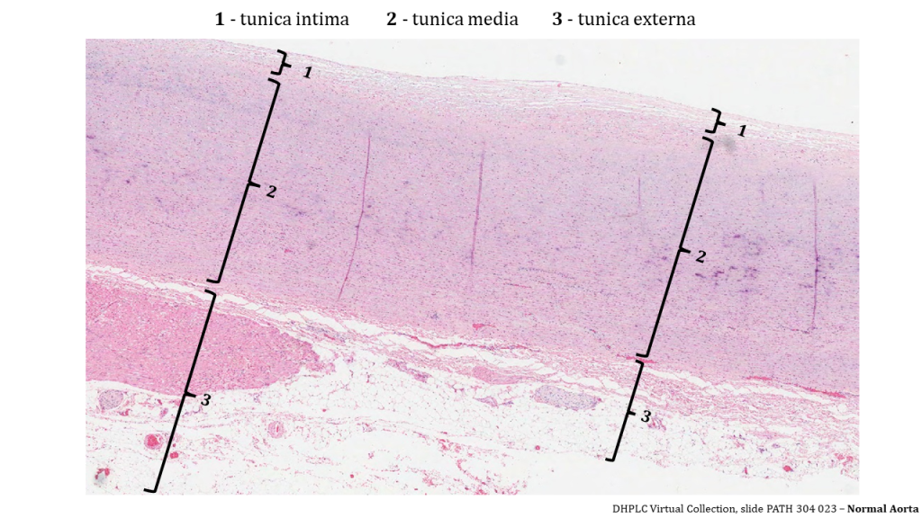 layers of the aorta is visible and enumerated with 1 (tunica intima) at the top of the image, 2 (tunica media) which fills up the middle of the image), and 3 (tunica externa) which occupies the bottom. All layers are a light pink colour with a sense of parallel layers. The tunica intimal layer show discrete layers of cells atop each other. The medial layer has many dark pink dots suggesting nuclei of sm muscle cells. The externa has a variety of tissues including fat (all white with no stain), and dark pink with purple nuclei.