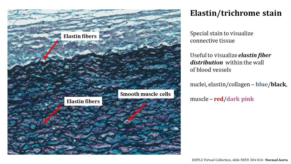 microscopic view of the aorta stained blue, black, red, and dark pink. The image looks like multiple parallel waves: the top most being light blue suggesting presence of elastin/collagen. The lower image shows lots of black and purple (blue +red) suggesting muscle tissue with lots of collagen