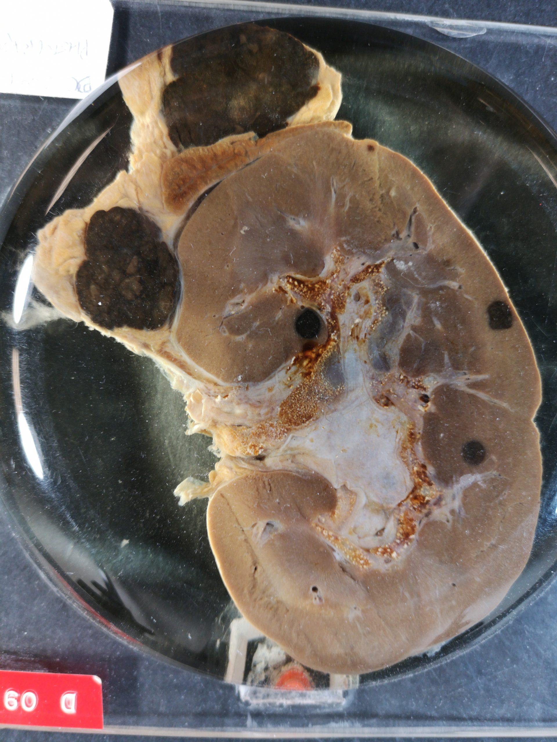 a kidney and adrenal are visible with large, obvious black spots within and on top of the kidney. These black spots are melanoma metastases