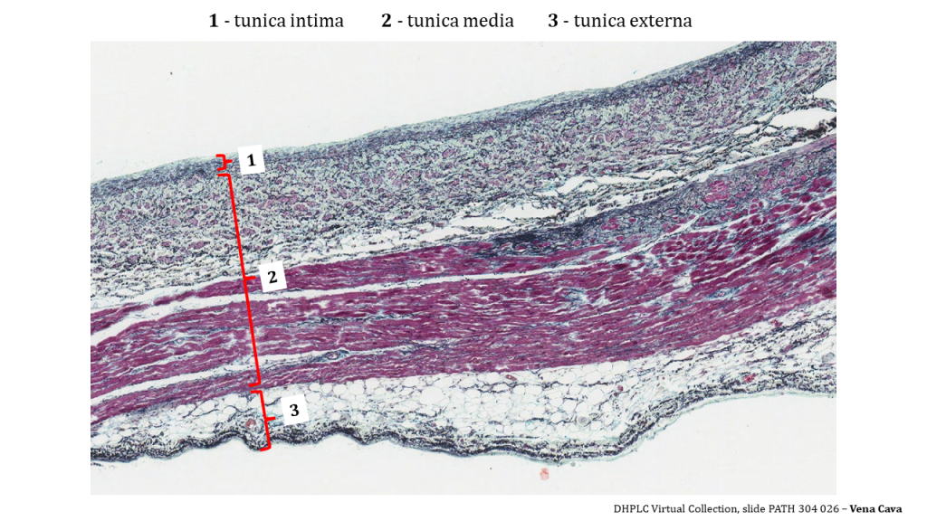 layers of the vena cava is visible and enumerated with 1 (tunica intima) at the top of the image, 2 (tunica media) which fills up the middle of the image), and 3 (tunica externa) which occupies the bottom. The tunica intima and half of the media stain a dark blue/black with a background colour of pink. The lower half of the the tunica media stains dark purple, with a sense of parallel layers, suggestive of a lot of collagen and elastin. The externa has a variety of tissues but mostly fat (all white with no stain).