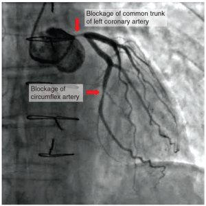 Atherosclerotic Coronary Arteries In this coronary angiogram (X-ray), the dye makes visible two occluded coronary arteries. Such blockages can lead to decreased blood flow (ischemia) and insufficient oxygen (hypoxia) delivered to the cardiac tissues. If uncorrected, this can lead to cardiac muscle death (myocardial infarction).