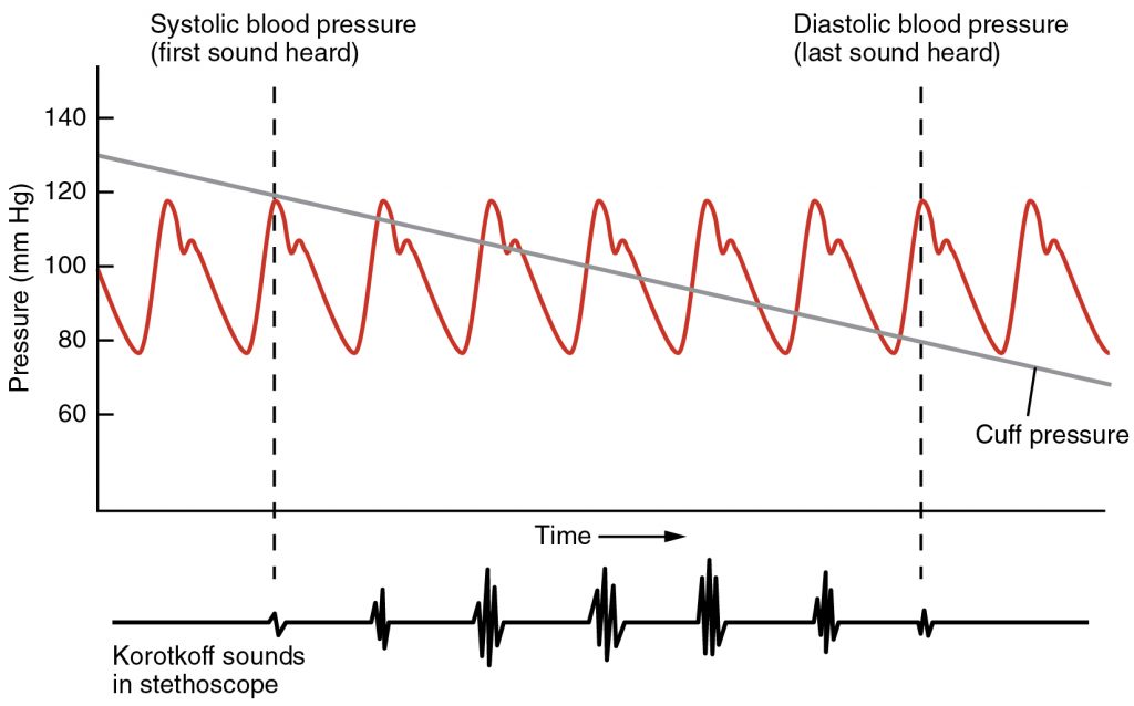 This image shows blood pressure (y-axis) vs time (x-axis) On the bottom is a sonogram which represents the korotkoff sounds heard from a stethoscope during blood pressure measurement. The blood pressure is a red oscillating peak wave that consistently cycles between 120 & 80. A slow decreasing line from 130 descend across the graph to 80 as this represents the blood pressure cuff pressure.